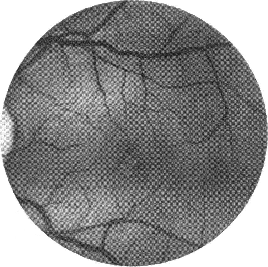 Fluorescein angiography showed early hyperfluorescence in the macular region in a ring-like Fig. 1 (Case 1) Left macula with vitelliform-like lesion. fashion in a window defect pattern OU.