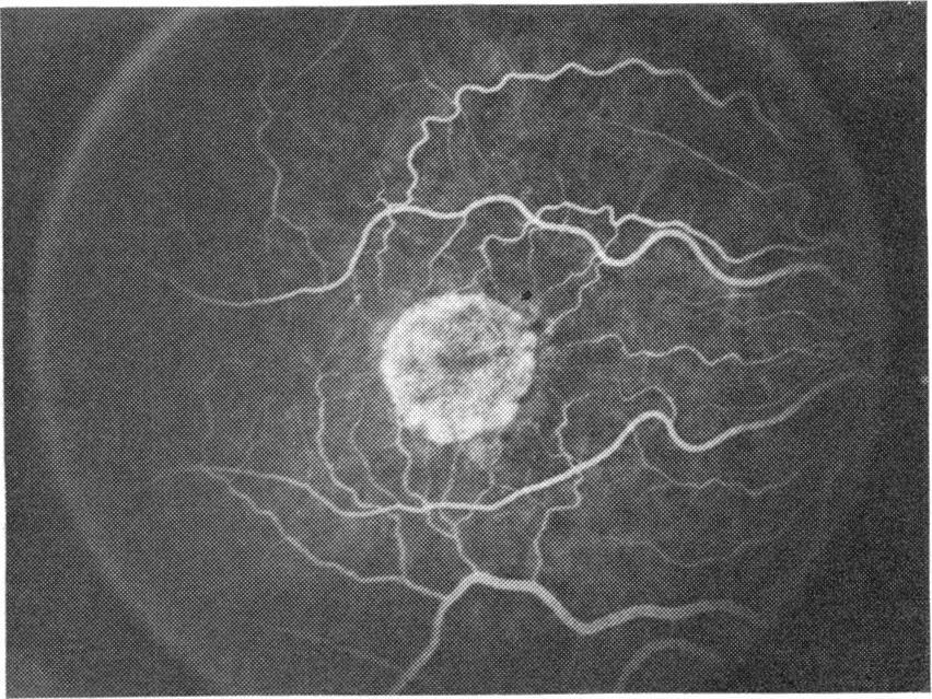 13 The patient denied any history of metamorphopsia, photopsia, photophobia, or previous ocular problems. He had cardiac arrhthmias that were being treated with a pacemaker.
