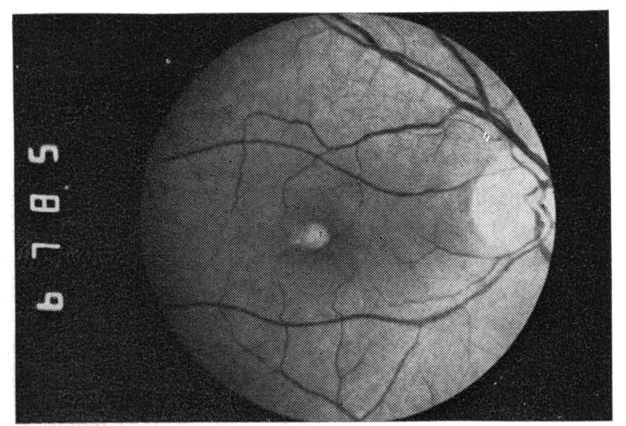 736 Fig. 6 (Case 4) Right eye showing umbilicated vitelliform lesion with central hyperpigmentation. noted in the left eye. No other retinal or choroidal pathology was noted.