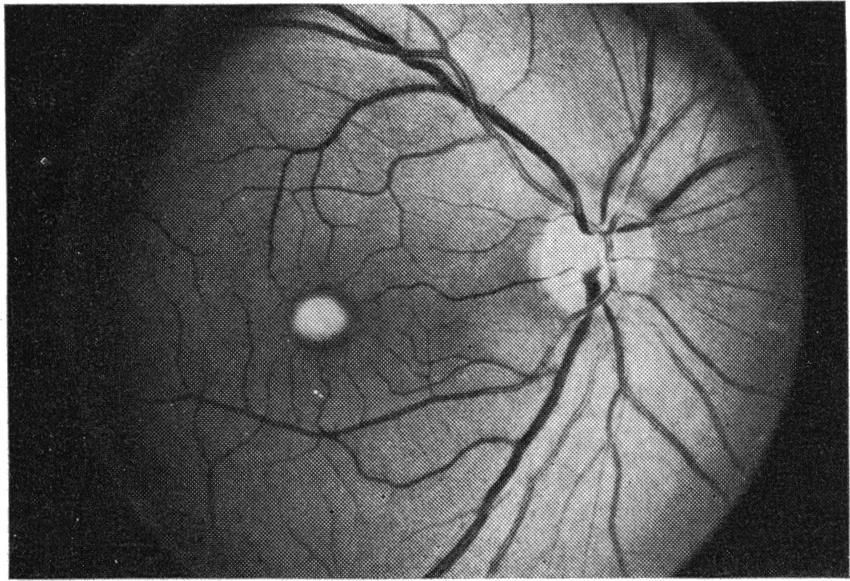 Adult vitelliform macular degeneration Fig. 8 (Case 7) Right eye with i to 1 13 raised adult vitelliform lesion (1974). pia in both eyes, the right eye being worse than the left.