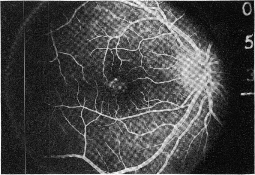 Angiography revealed a faint ring of hyperfluorescence in the foveal region. In 1975 electrical studies were normal, and the patient was told that she did not have Best's disease.