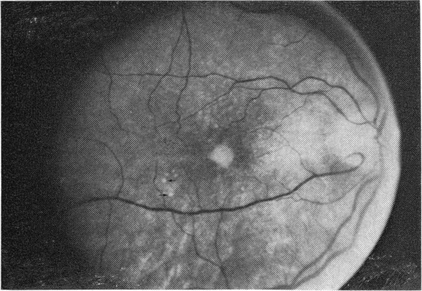 Fluorescein angiography of the right eye disclosed an early hyperfluorescent ring type window defect in the macular region.