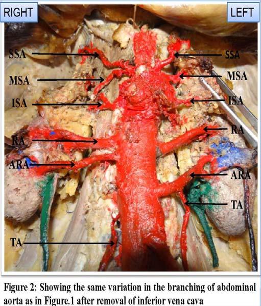 The renal arteries originated from the abdominal aorta at the level of second lumbar vertebra about 1 1.5 cm below the origin of the superior mesenteric artery.