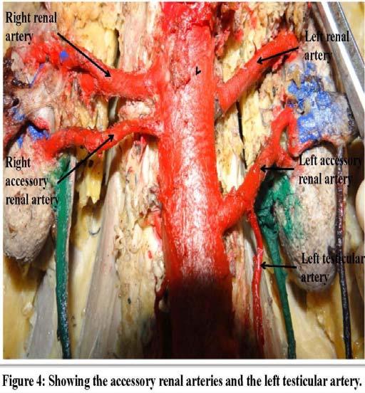 The inferior suprarenal arteries on both sides originated from the abdominal aorta at the level of origin of the superior mesenteric artery (at the level of lower border of L1 vertebra).