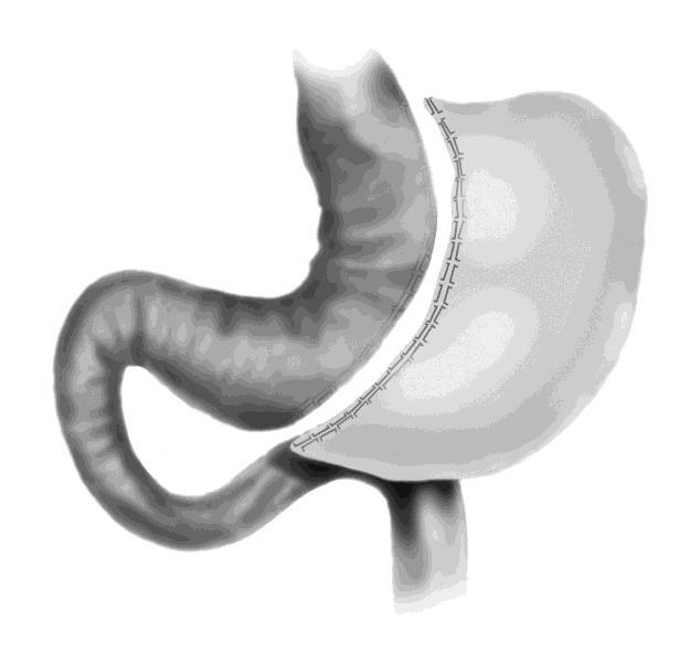 Sleeve Gastrectomy How is it done? A surgeon makes several small openings in the abdomen to place the laparoscopic (surgical) tools. Surgical staples are used to divide the stomach into two sections.