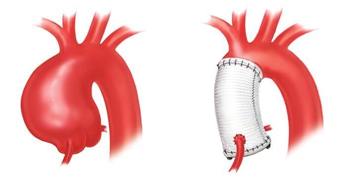 Some ascending aortic aneurysms involve the root of the aorta and require replacement with re-implantation of the coronary arteries into