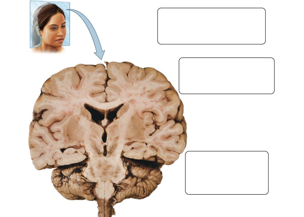 Cerebrum The corpus callosum is a band of white matter that allows communication between the cerebral hemisperes.