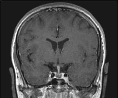 MRI with Thickened Pituitary Stalk