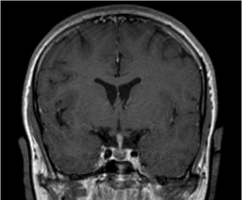 Initial MRI of DI patient MRI Results