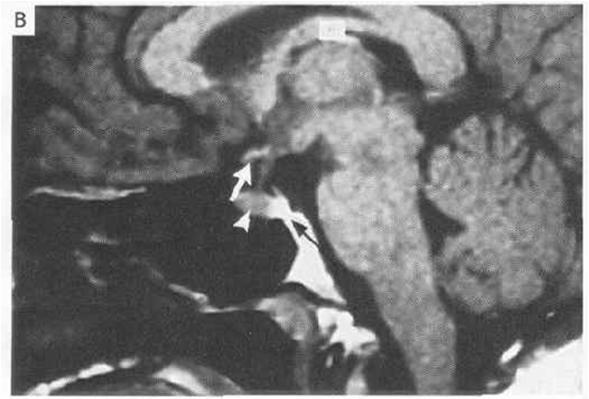 Normal Bright Spot on T1 MRI in DI: Loss of hyperintensity?