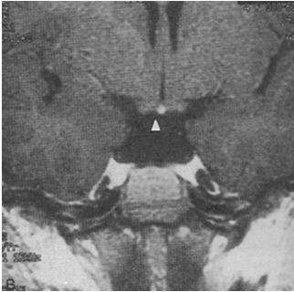 GPA 4 MRI with Ectopic Posterior Pituitary Ectopic Posterior Pituitary (EPP) *DI