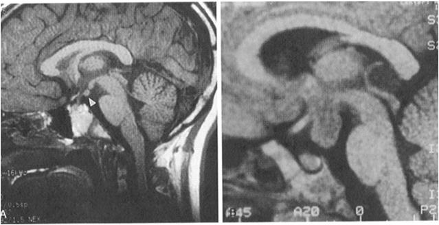 Precocious Puberty *Normal *Hamartoma (neural cells, wrong location) *Mass outside of the sella Harmartoma Understanding the MRI Bright spot present?