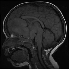 Craniopharyngioma There are two pathologic variants