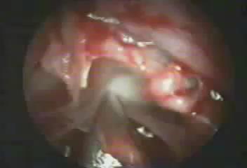 Transplanum Approach Endoscopic view obtained in a cadaver showing the removal of the superior portion of the nasal septum and the anterior sphenoidotomy.