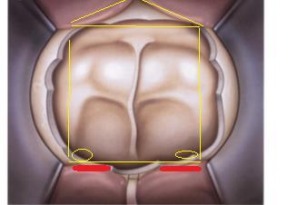 Endoscopic view obtained in a cadaver showing the removal of the superior portion of the nasal septum and the anterior sphenoidotomy.