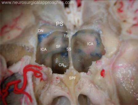 Planum Sphenoidale (PS) Bone covering the anterior