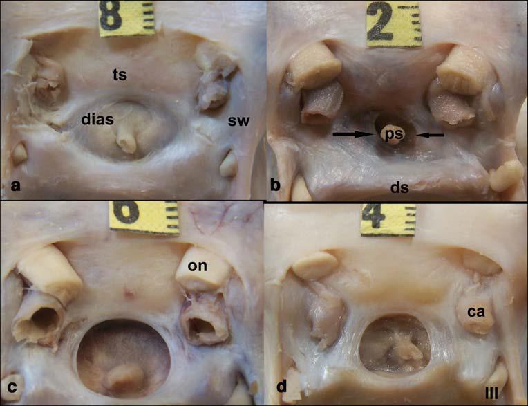 dura separating the pituitary