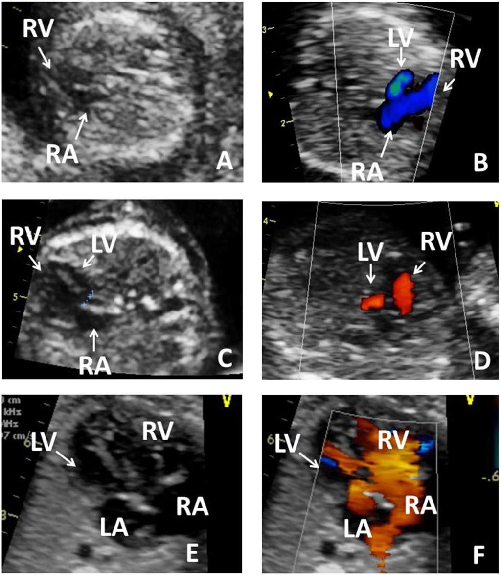 Early fetal echocardiography 793 A structural cardiac anomaly was found in 32 out of 142 fetuses (22.5%) (Table 3).