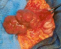 uterine, cervical, testicular, and pancreatic cancers Our patient had no mucocutaneous