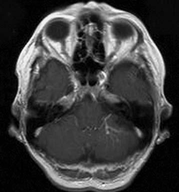 developmental venous anomaly located in the left cerebellar hemisphere.
