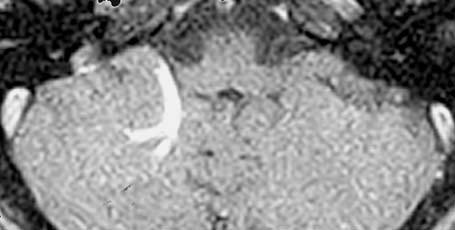 Notice the increased visibility of the cavernoma on the T2* image (c) compared to the standard T2 (b).
