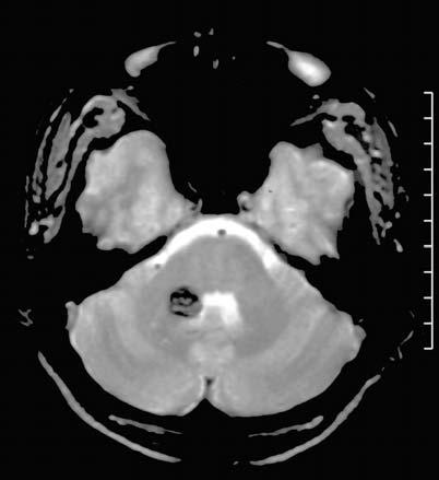 a b c d these patients need an imaging work-up with T2*- weighted MRI sequences to exclude or to visualize associated cavernomas with the highest sensitivity.