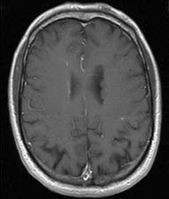 6 M. Forsting and I. Wanke a b c Fig. 1.6. a Axial contrast-enhanced T1- weighted image with a small developmental venous anomaly (DVA) in the left hemisphere.