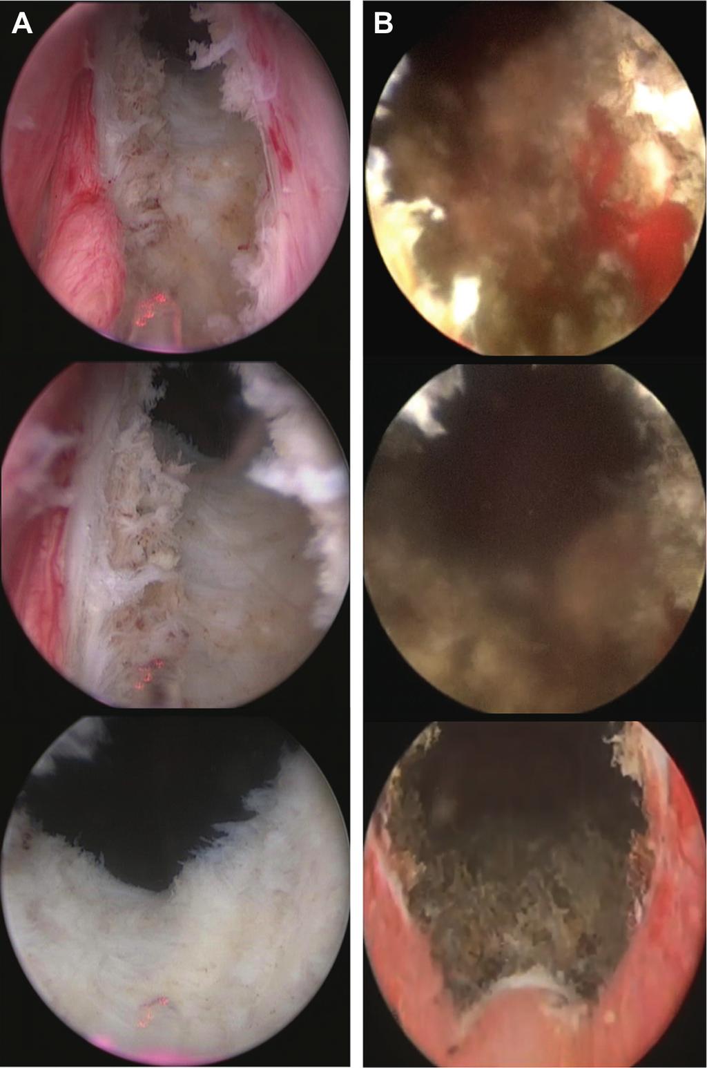 150 COMPARISON OF LASER TECHNIQUES FOR BENIGN PROSTATIC HYPERPLASIA Figure 1. Hol-TUIP (A) and PVP with GreenLight HPSÒ (B) Tertiary.