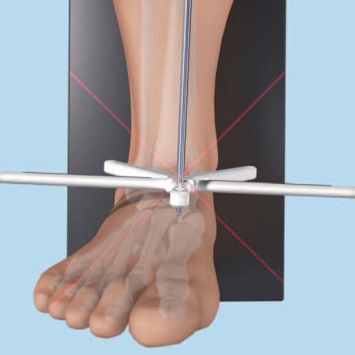 Handling Technique 3 Distal placement Align the distal end of the