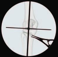 4 Verify knee joint line Verify that the projected axis line passes