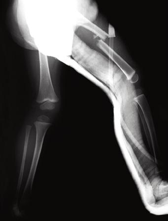 TYPICAL FEMUR FRACTURE MANAGEMENT Age Range Intervention 0-5 years old Spica cast* 5-10 year old females 5-12 year old males 10 years and older females 12 years and older males Flexible IM nailing