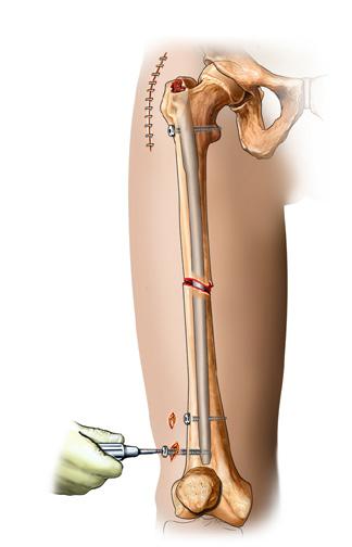 general anesthesia. The surgeon will make an incision near the hip joint in order to insert a rigid rod (intramedullary nail) through the femur.