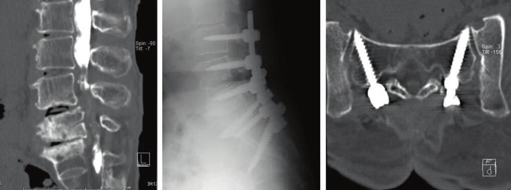 Fukuda et al. Scoliosis 2014, 9:8 Page 3 of 5 screw axes; the ZODIAC Spinal Fixation System (Alphatec Spine, Inc., Carlsbad, CA, USA) and the EXPEDIUM Dual Innie System (DePuy Synthes Spine, Inc.