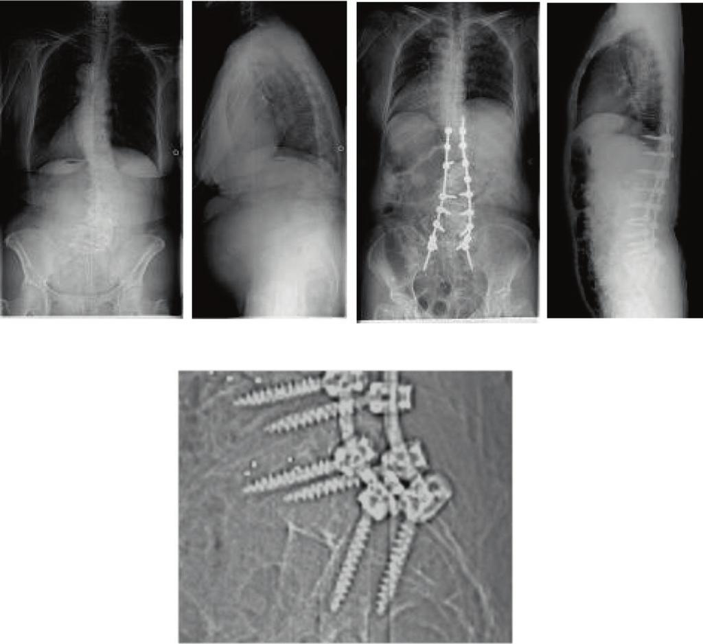 Fukuda et al. Scoliosis 2014, 9:8 Page 4 of 5 A B C D E Figure 4 Radiographs of a 77-year-old female with degenerative kyphoscoliosis. A: Posteroanterior view of the preoperative whole spine.