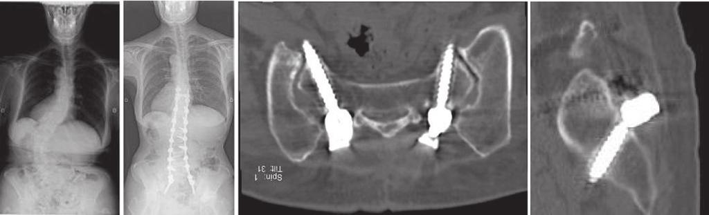 E: Intrasacral screws are seen in the magnified view of the lumbosacral junction. a thoracolumbosacral orthosis beginning on postoperative day 20.