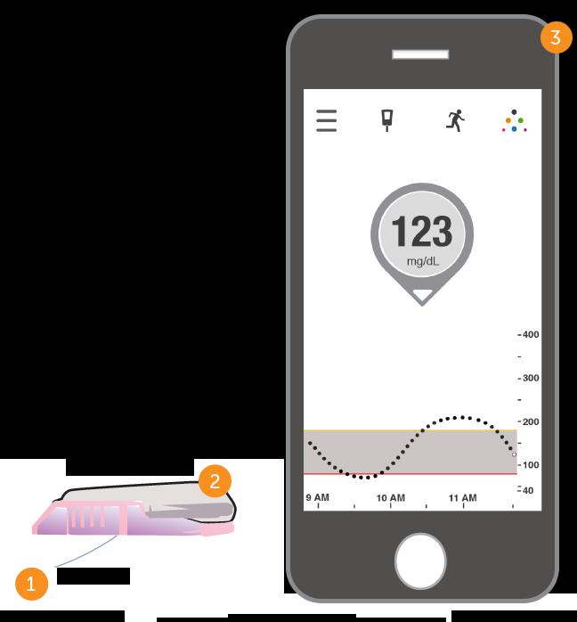 Dexcom G5 Mobile System Overview Sensor: measures glucose levels just underneath the skin.