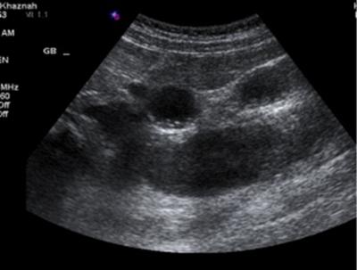 Figure 2 Figure 2: Ultrasonography of the liver showing a dilated tubular structure posterior to the gallbladder with internal