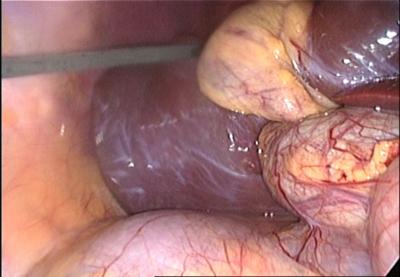 Intraoperatively, the gallbladder was distended, but not inflamed (figure 3).