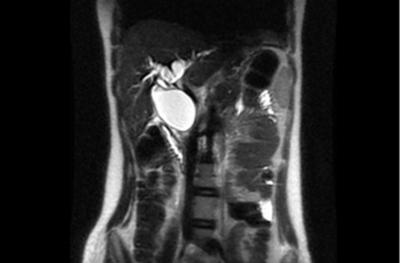 Figure 7 Figures 7 & 8: Postoperative MRCP confirming the diagnosis of a choledochal cyst. Subsequently, the patient had excision of the cyst with hepaticojejunostomy without complications.