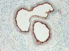 gland (ductal differentiation): -