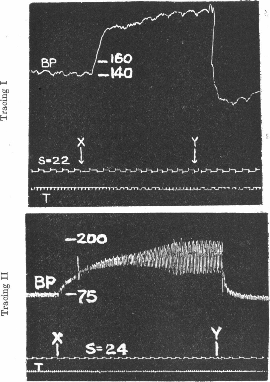 192 H. BARCROFT. of the blood-pressure and systemic output in the two preparations are comparable. Fig. 5. Tracing I. Animal 1. At X the thoracic aorta was completely occluded.