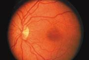 extracting the location and size of exudates in the retinal images. In color fundus images they appear as yellow white deposits (see Fig. 1).