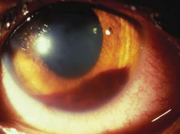 HYPHEMA THERAPHY TOPICAL STEROIDS