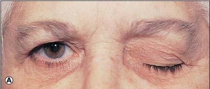 SUBCONJUNCTIVAL HEMORRHAGE SPONTANEOUS - ETIOLOGY USUALLY UNDETERMINED COUGHING, SNEEZING = physical pressure HYPERTENSION ANTICOAGULANTS IF TRAUMATIC, MAKE SURE THERE IS NO OTHER INJURY; MAY MASK AN