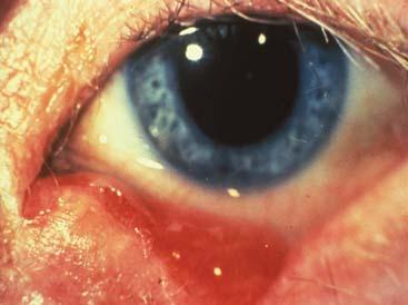 sac lacrimal duct EYELID LACERATIONS (repairs) MINOR HORIZONTAL CUTS CAN BE SUTURED
