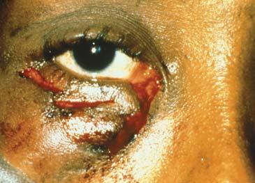 INTEGRITY FOREIGN BODIES: CONJUNCTIVAL INSPECT THE CONJUNCTIVA TOPICAL ANESTHETIC