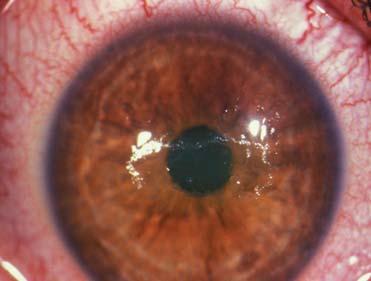 CORNEAL ABRASION: TREATMENT WARN OF CONTINUED PAIN SYSTEMIC