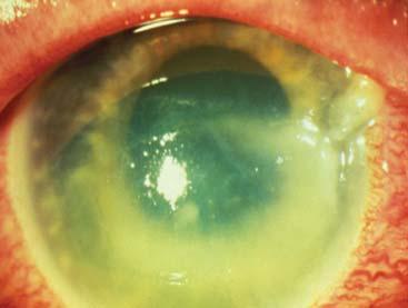 POTENTIAL RECURRENT EROSION FOREIGN BODIES: CORNEAL TOPICAL