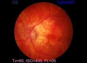 retinal disease One exam/eye/month is allowed for the patient who is