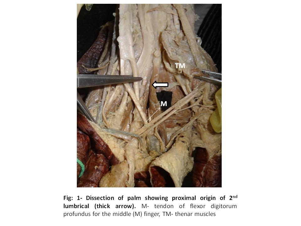 3 Plastic Surgery: An International Journal Fig: 1- Dissection of Palm Showing Proximal Origin of 2 nd Lumbrical